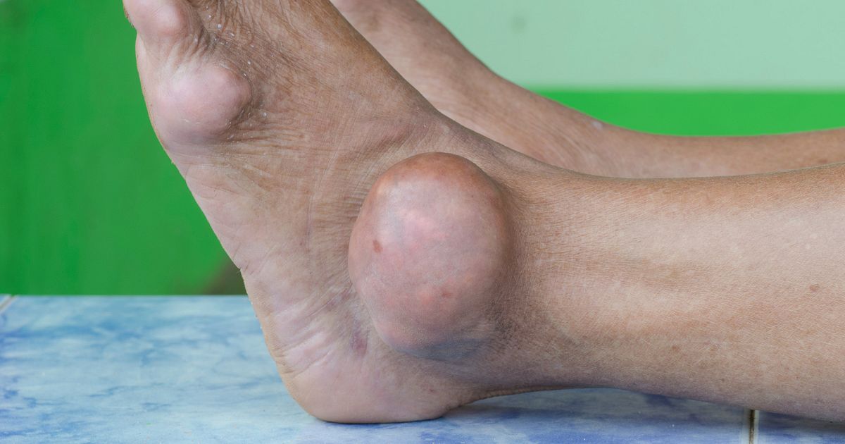 Gout Attacks Strike Mostly at Night