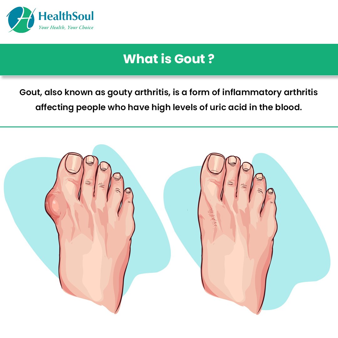 Gout: Causes, Symptoms and Treatment  Healthsoul