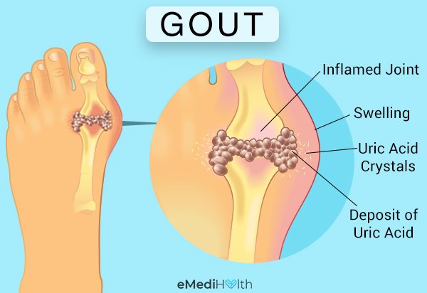 Gout: Causes, Symptoms, Diagnosis, &  Treatment