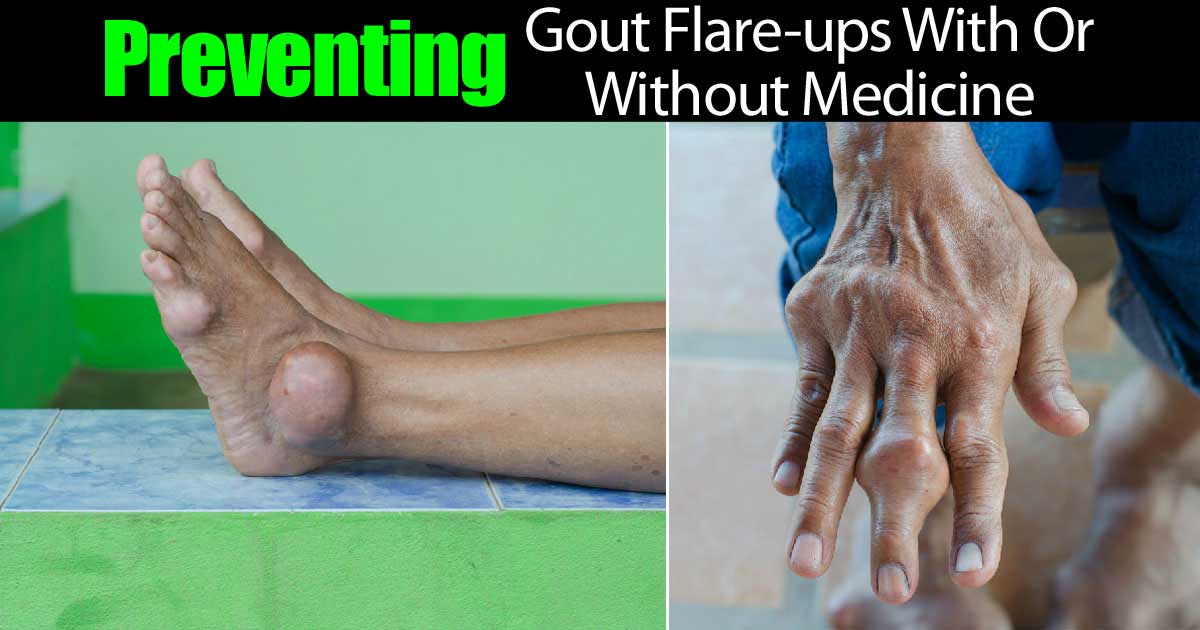 Gout Flare