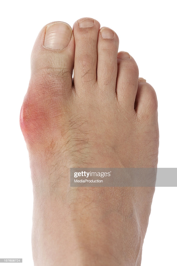 Gout Foot High