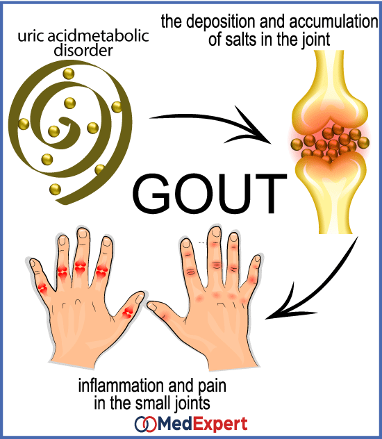 Gout (Gounty Arthritis, Crystal Arthritis)