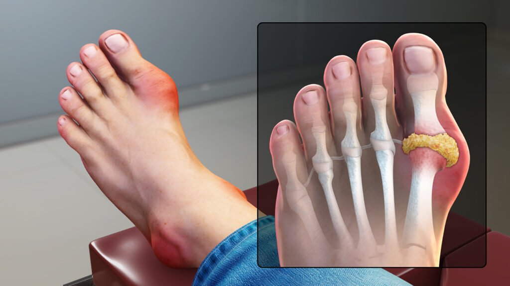 Gout in big toe: How to identify, causes, and treatment