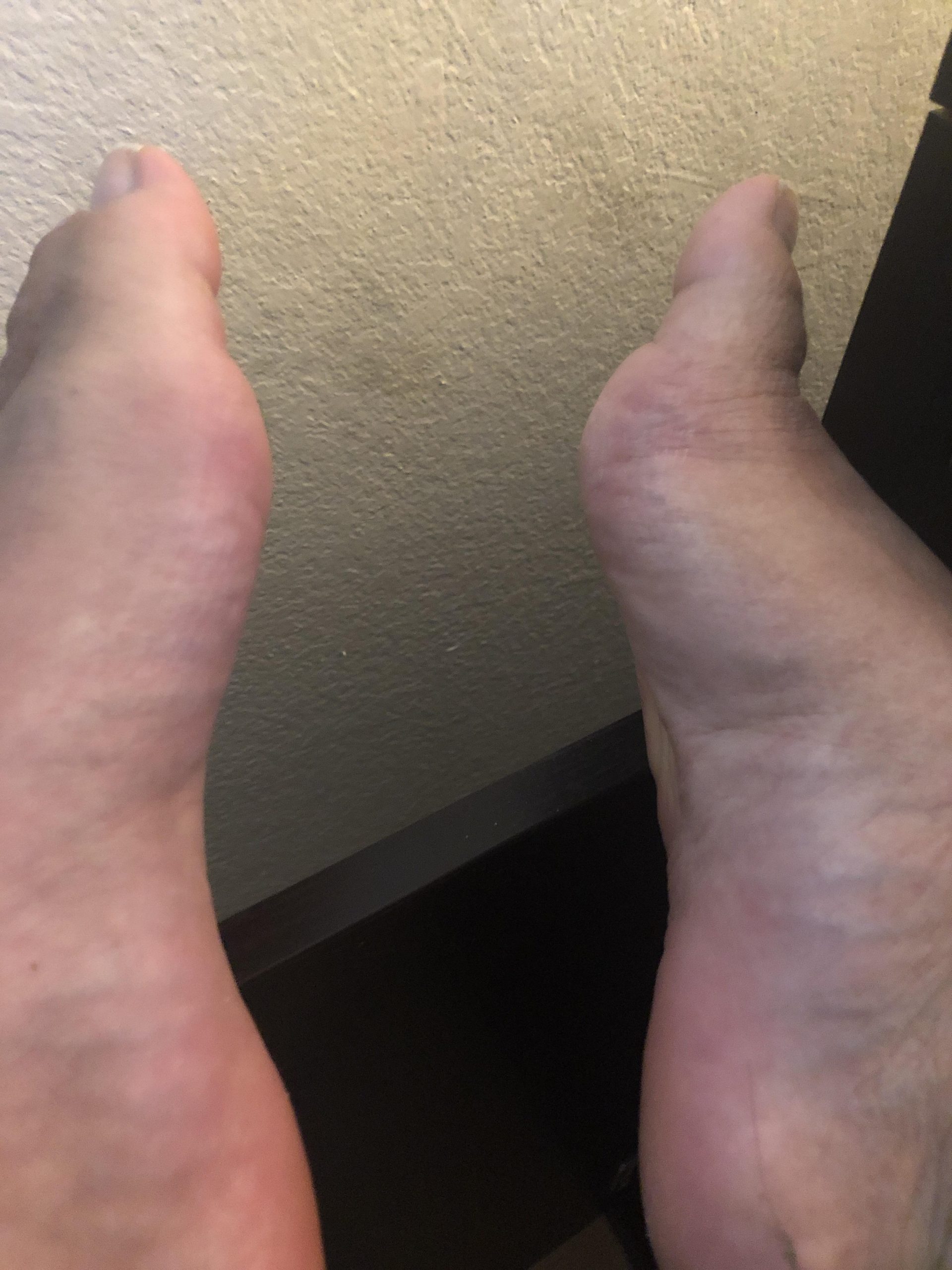 Gout in both my big toes! : gout