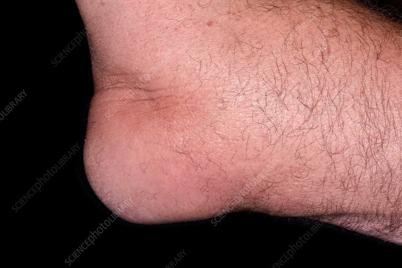 Gout in the elbow