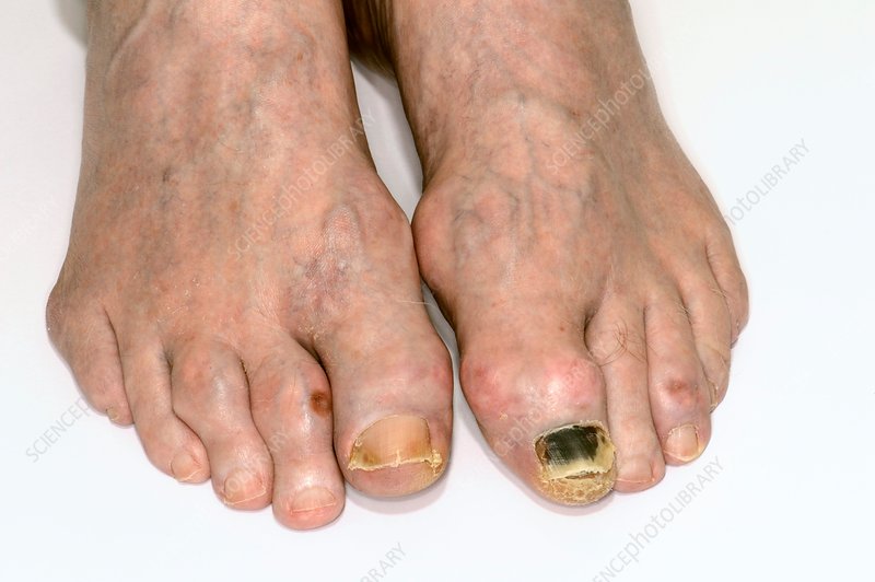 Gout in the toes