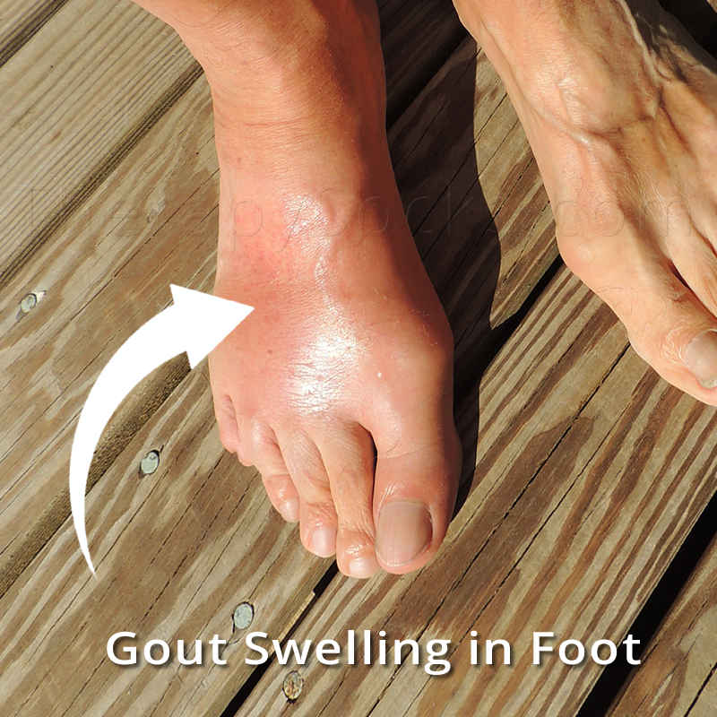 Gout in Your Feet