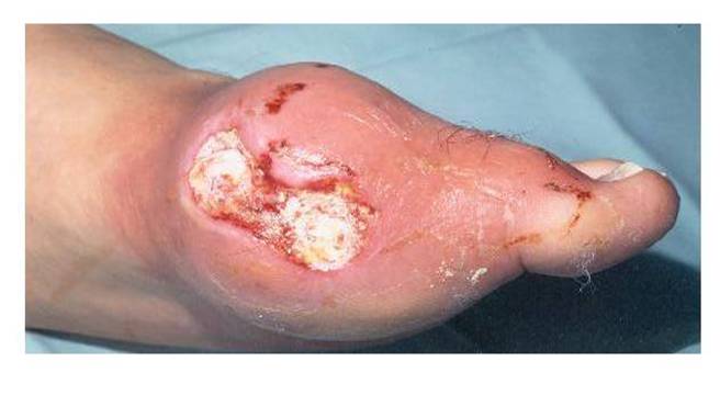 Gout Infection In The Foot: Is It Possible?