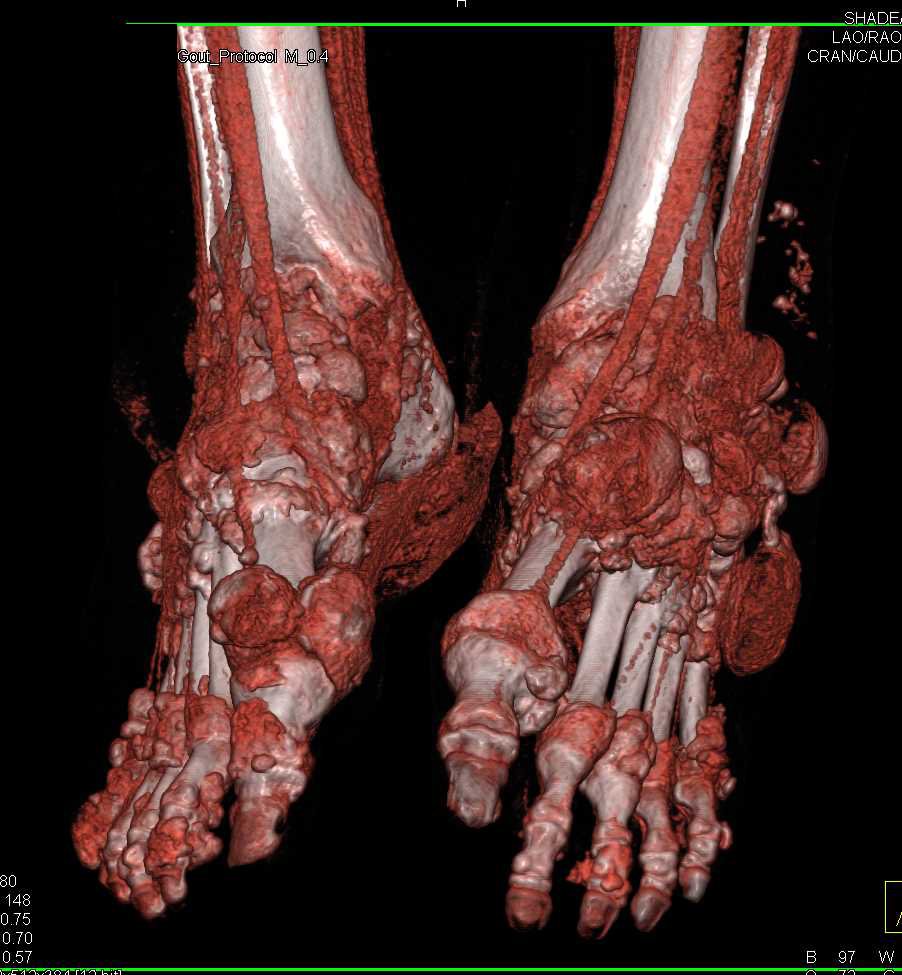 Gout Involves the Hands and Feet