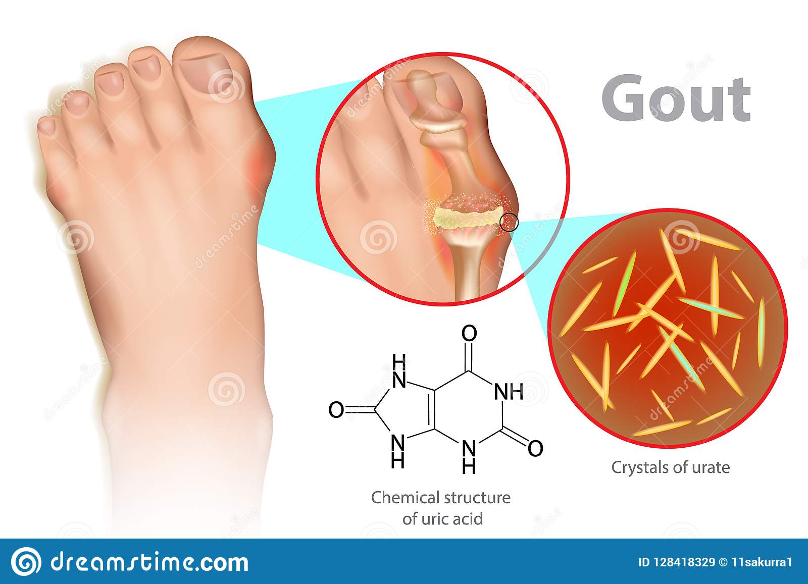 Gout Is A Form Of Inflammatory Arthritis Stock Vector ...