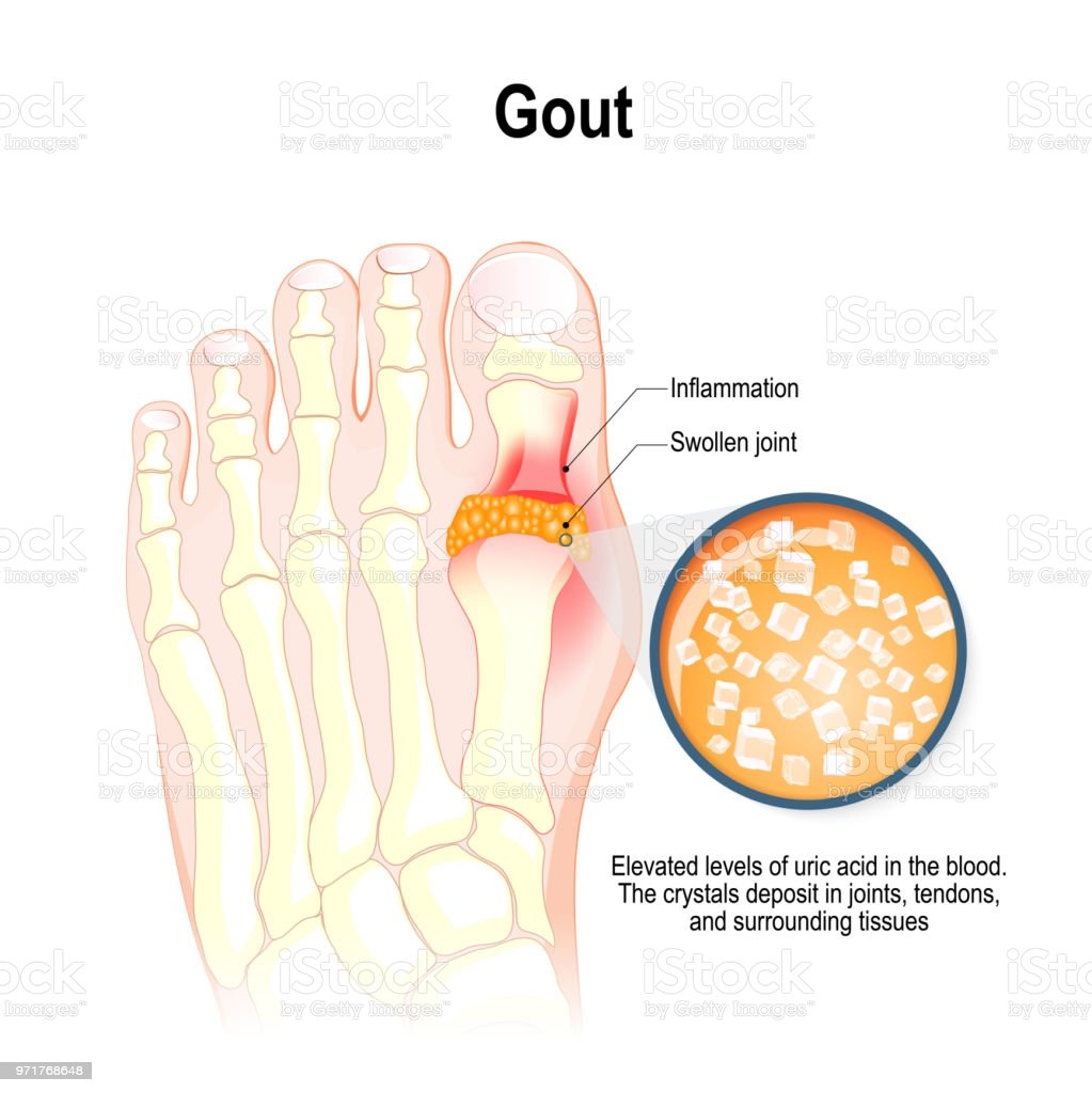 Gout Is A Form Of Inflammatory Arthritis Stock ...