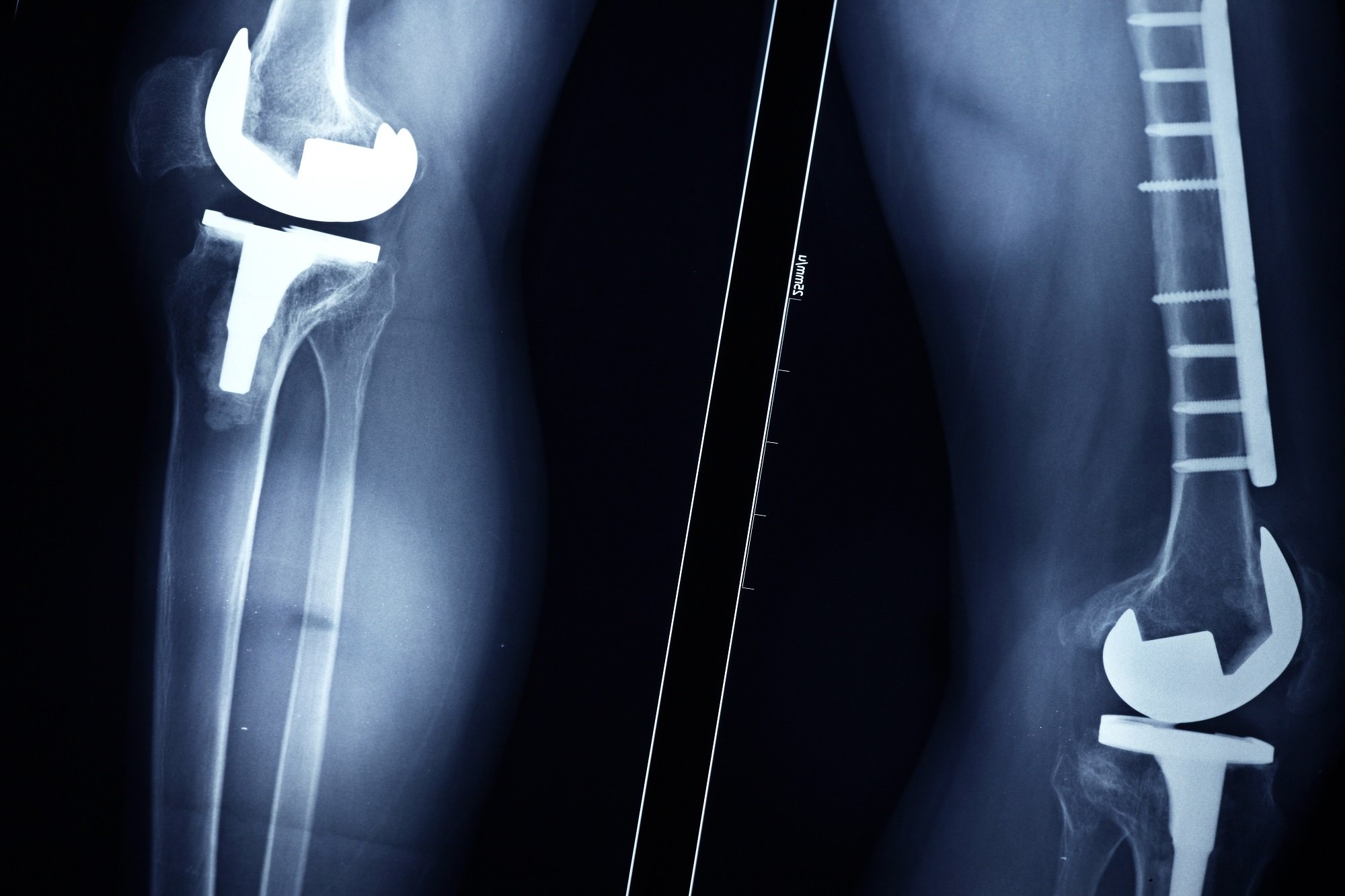 Gout Linked to Increased Healthcare Use After Total Knee Arthroplasty ...