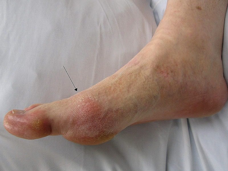 Gout Linked to Increased Vascular Disease Risk
