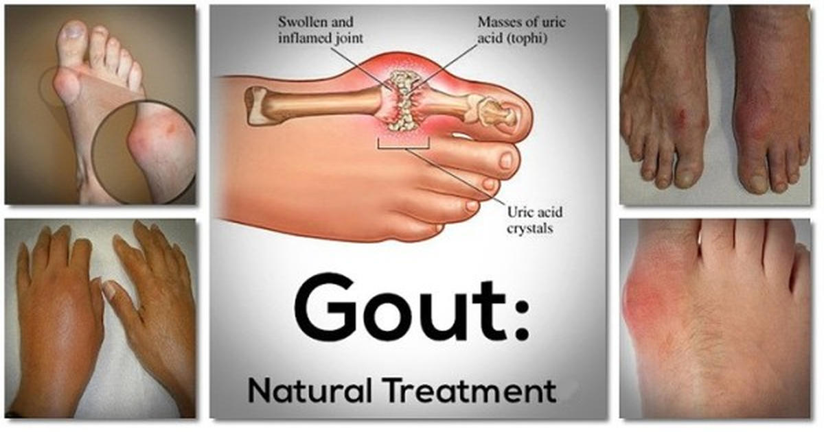 Gout Natural Treatment With Pinapple Juice