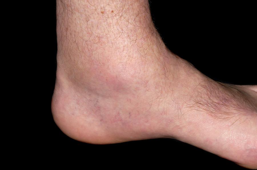 Gout Of The Ankle Photograph by Dr P. Marazzi/science ...