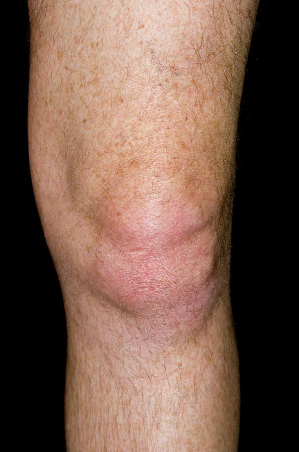 Gout Of The Knee Photograph by Dr P. Marazzi/science Photo Library