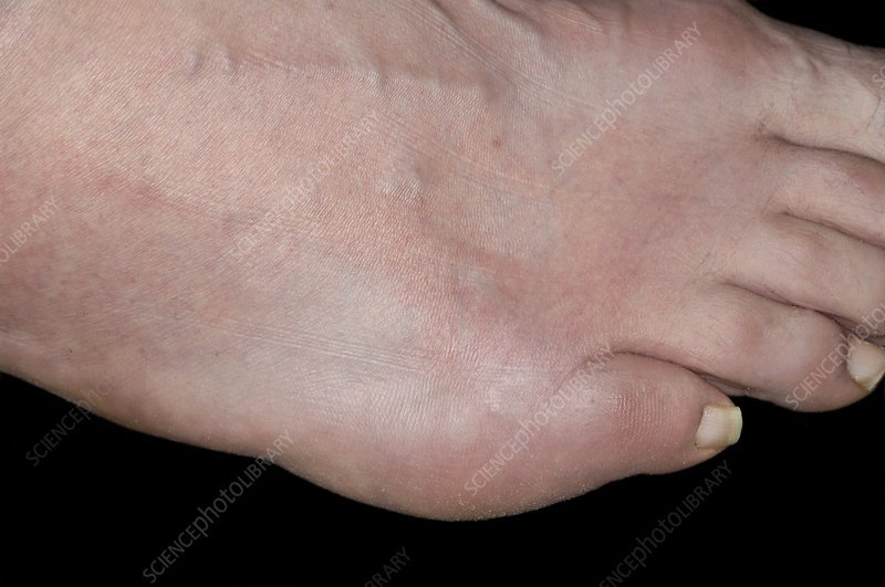 Gout of the little toe