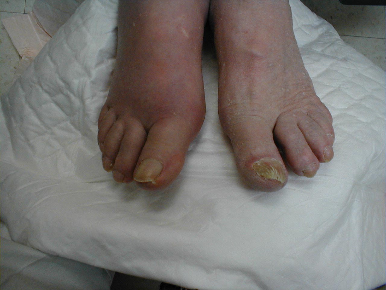 Gout of the Right Great Toe: Diffuse swelling and redness ...