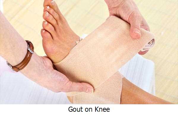 Gout On Knee