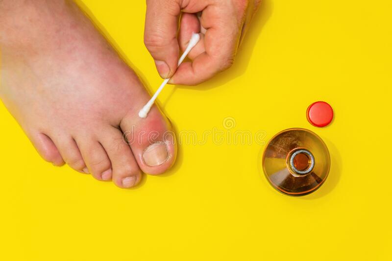 Gout On The Big Toe Treatment With Therapeutic Ointment Stock Image ...