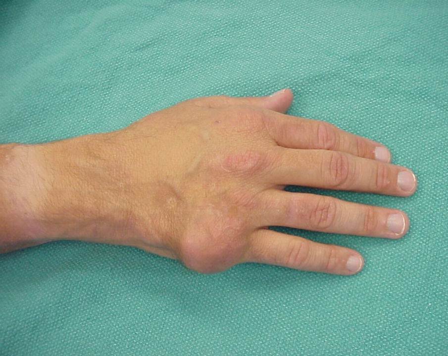 Gout on the hands pictures
