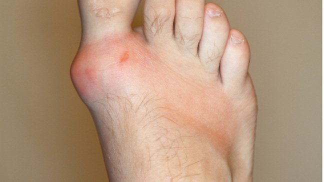 Gout: Overview &  Causes