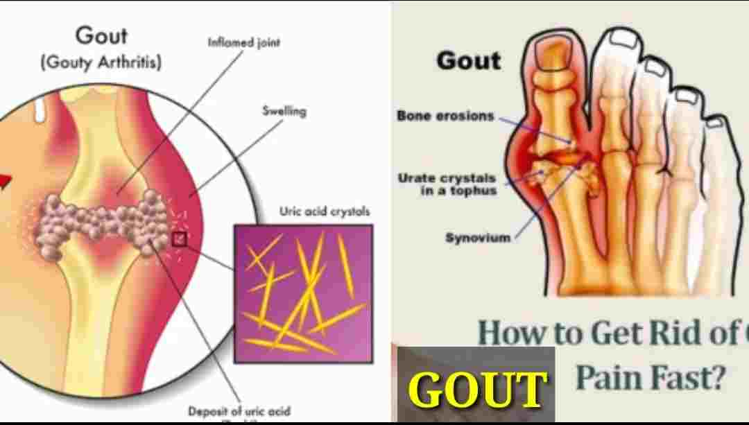 Gout Pain Relief: How to Get Rid of Gout Pain Fast