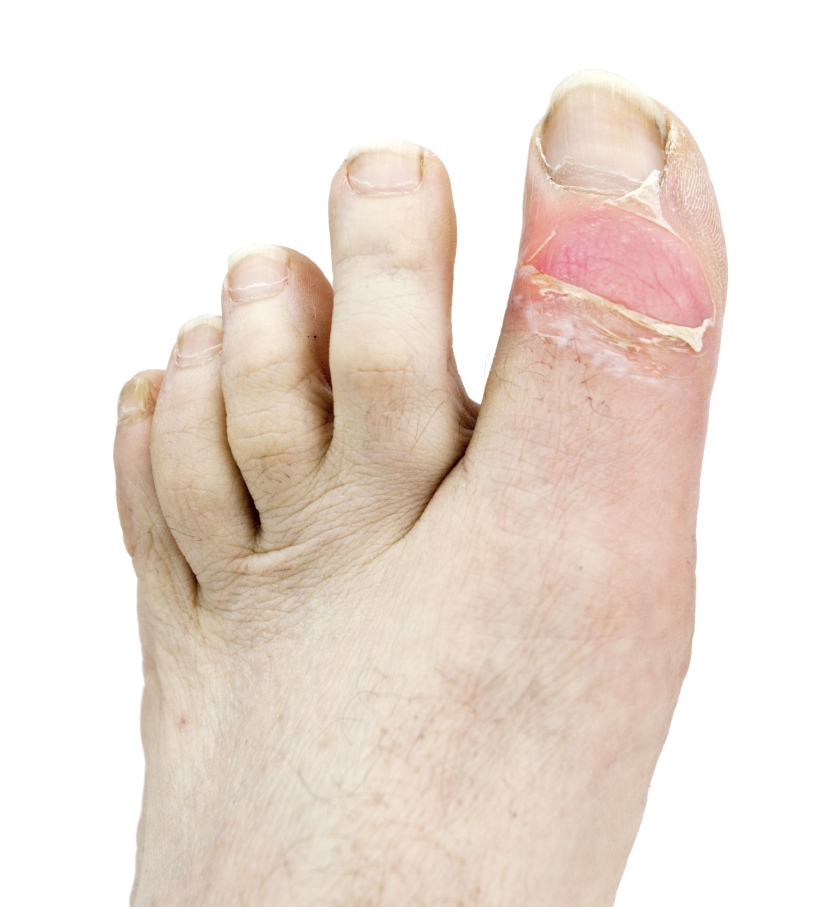 Gout: Signs, Symptoms, and Complications