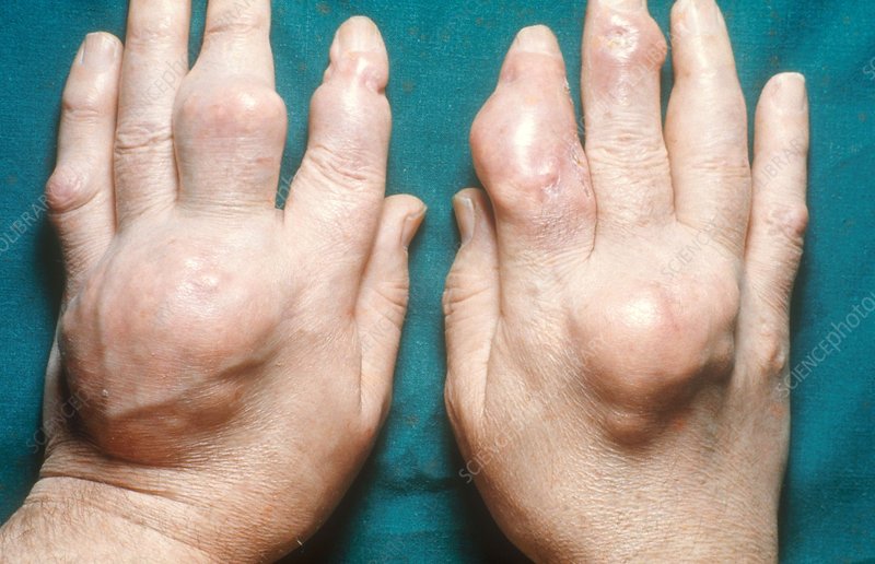 Gout Swelling, Hands