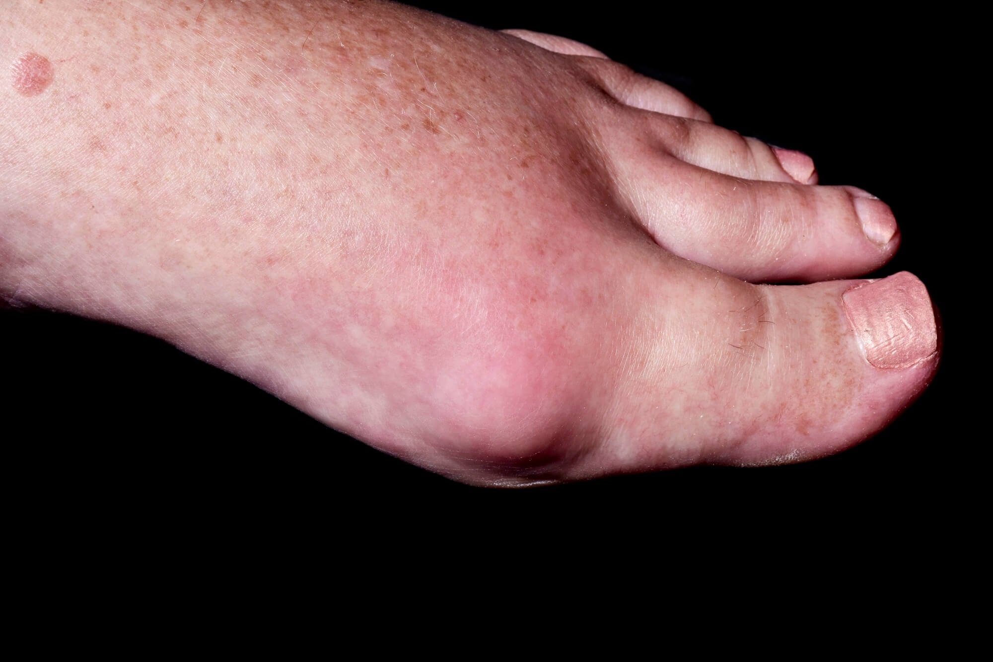 Gout Symptoms Ball Of Foot