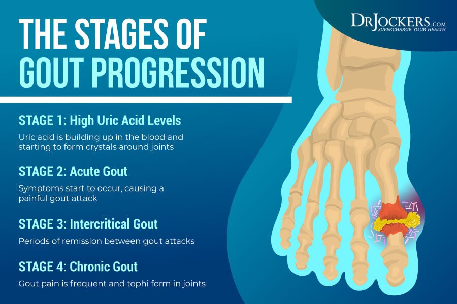 Gout: Symptoms, Causes and Natural Support Strategies