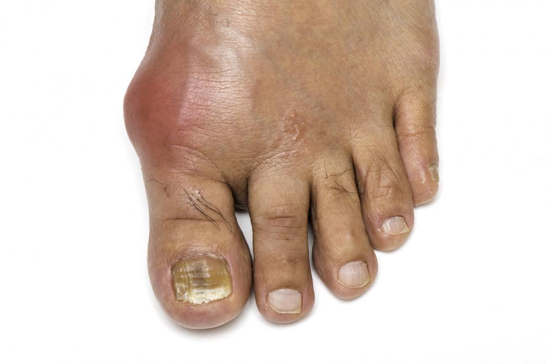 Gout: Symptoms, causes, and treatment