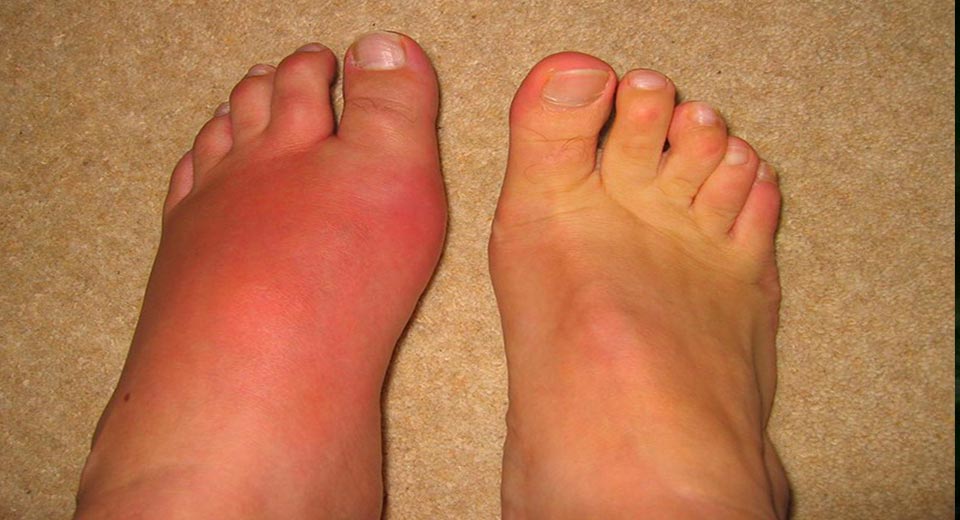 gout symptoms foot Archives