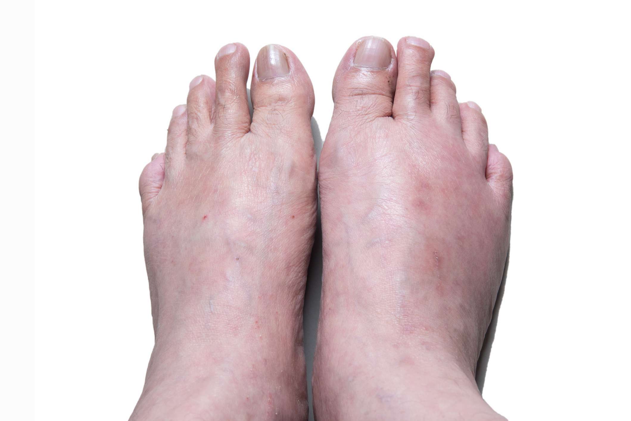 Gout: Symptoms, Pictures, Treatment, and More