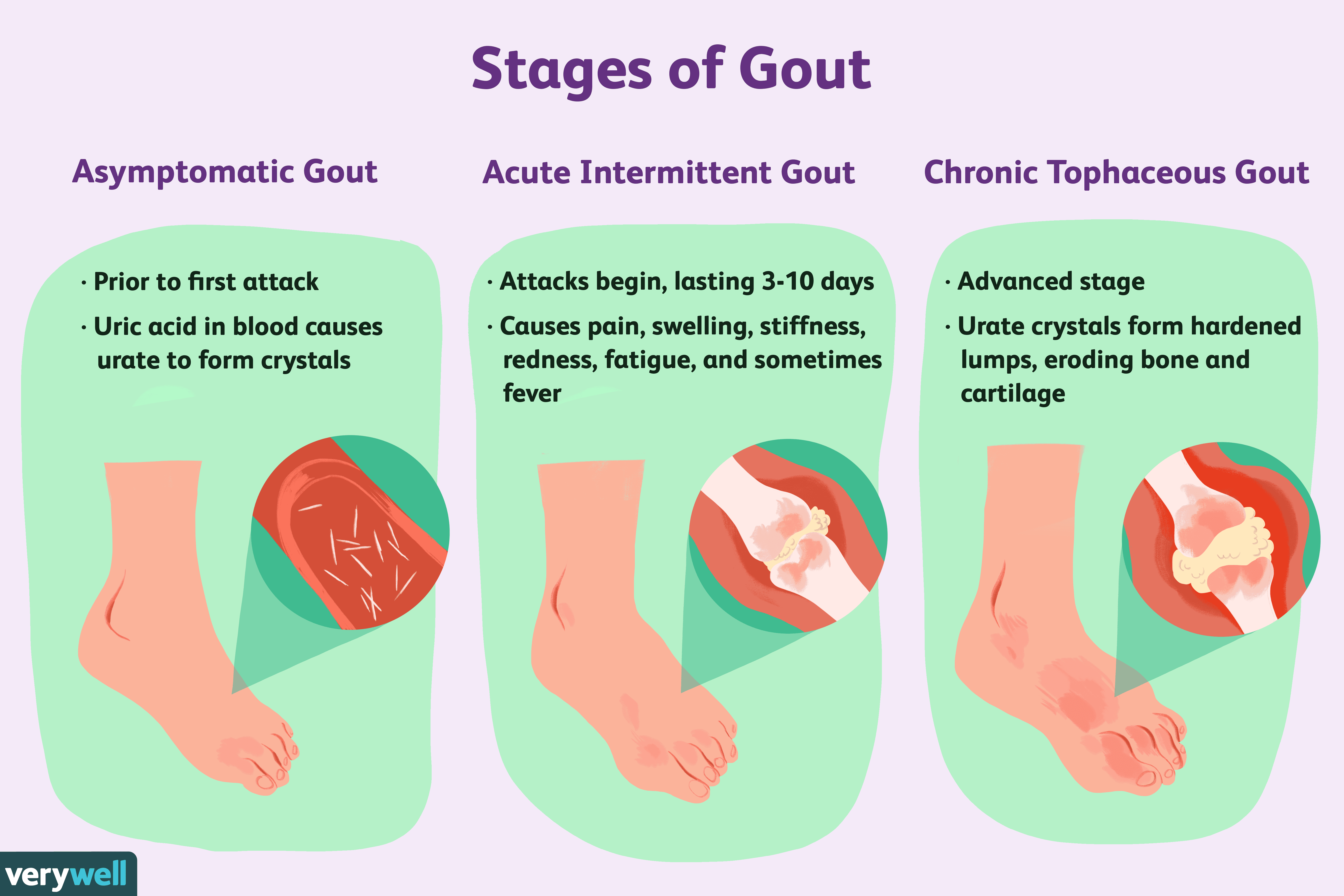 Gout: Symptoms, Pictures, Treatment, and More