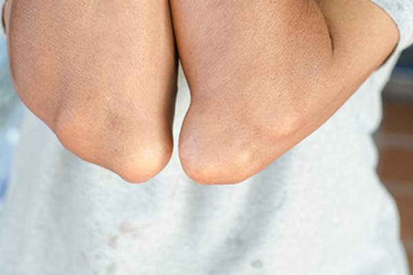 Gout: The Most Common Places It Flares