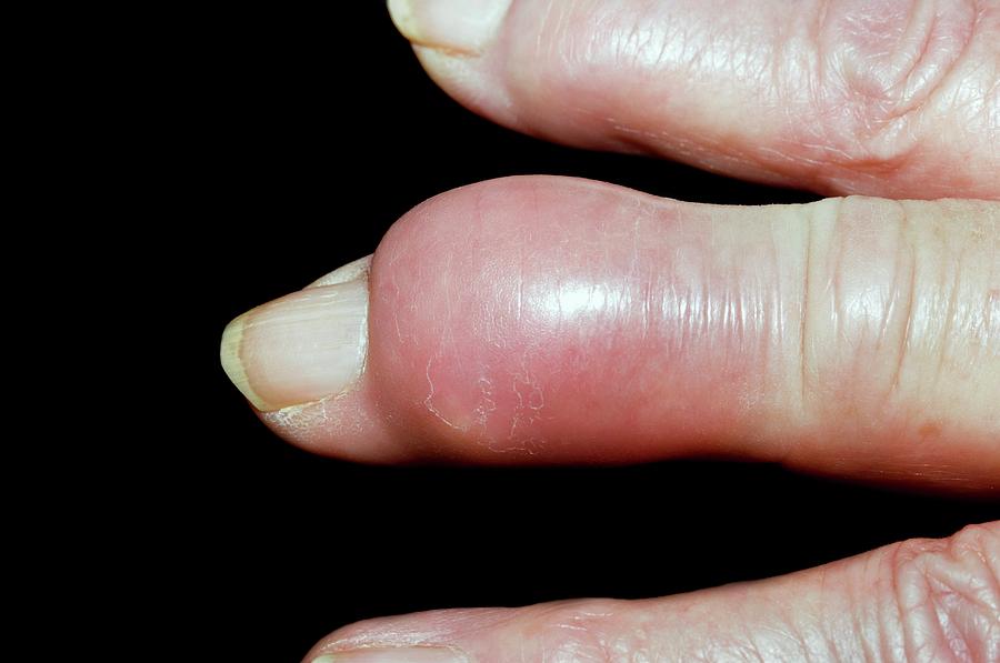 Gout Tophus On The Finger Photograph by Dr P. Marazzi ...
