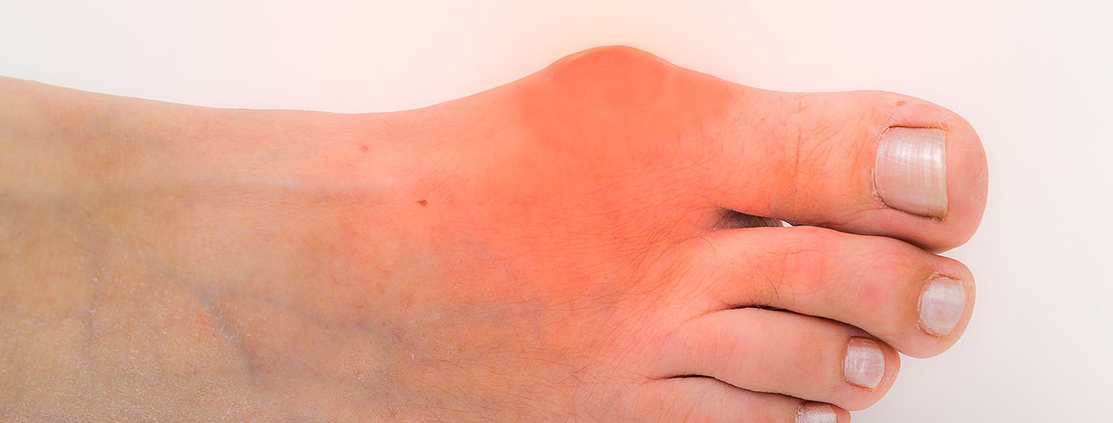 Gout Treatment and Gout Attack Pain Relief