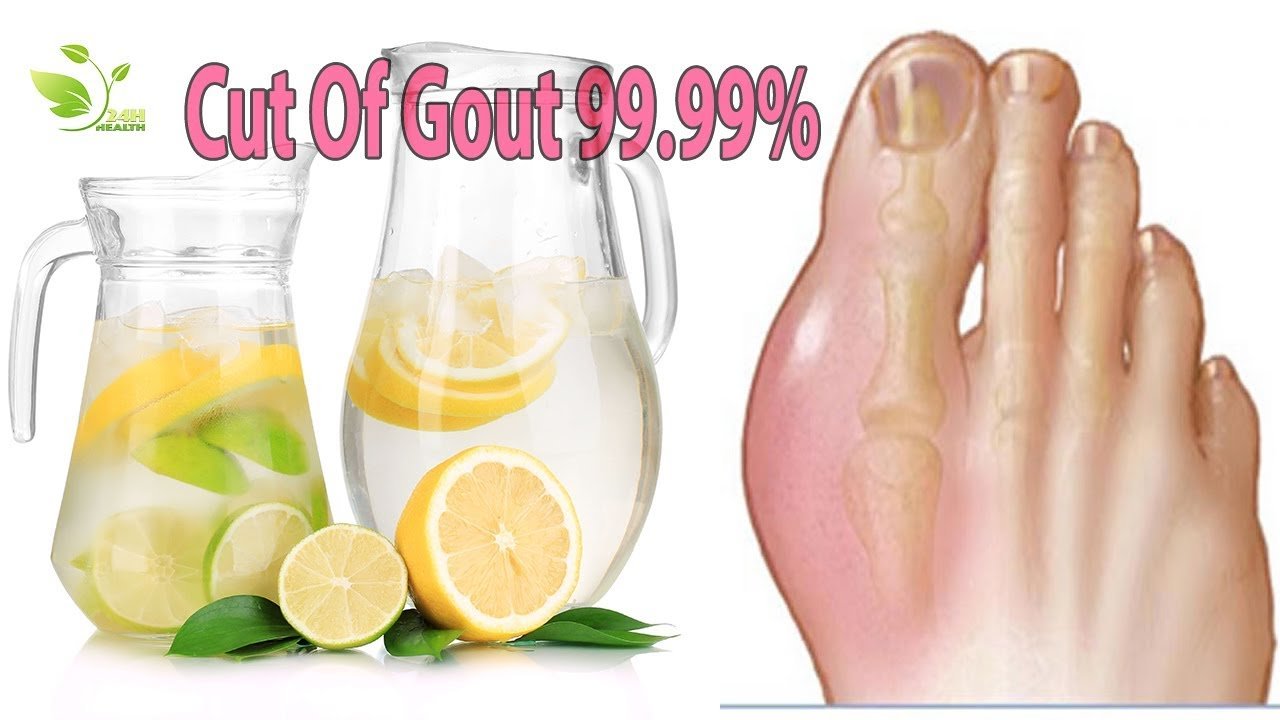 [GOUT TREATMENT] How To Cure Gout Fast At Home With Lemon Juice? It is ...