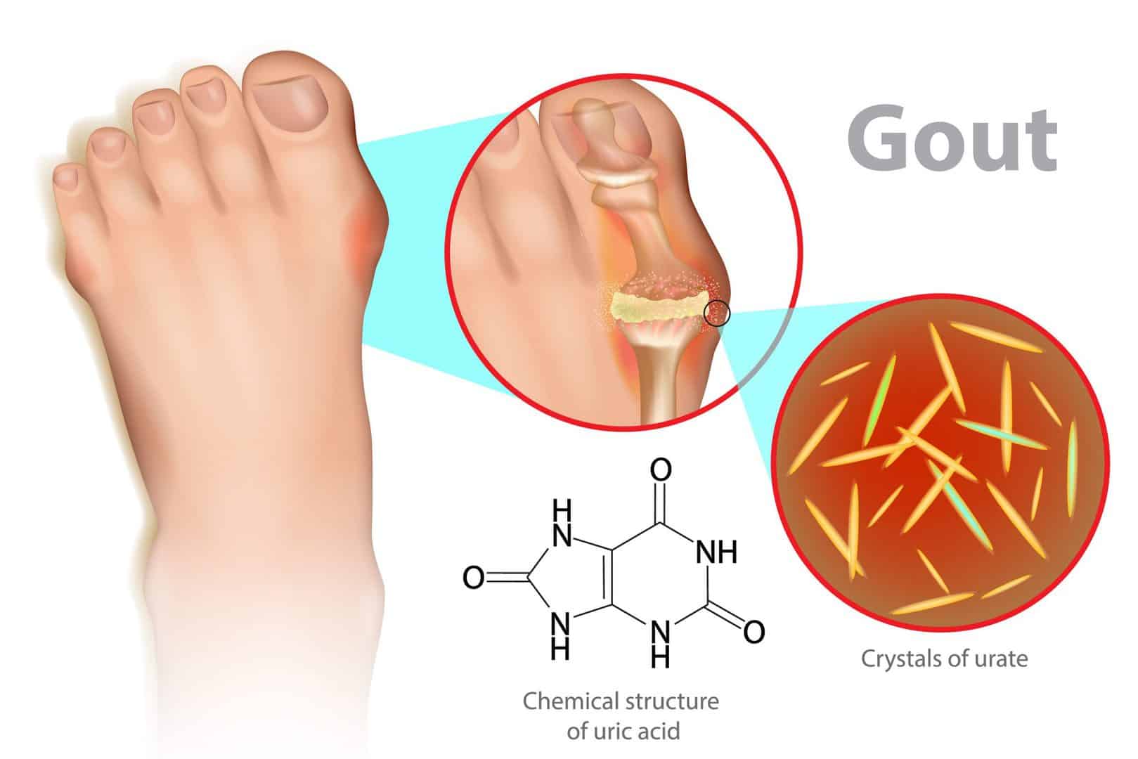 Gout Treatment &  Symptoms Podiatrist near me
