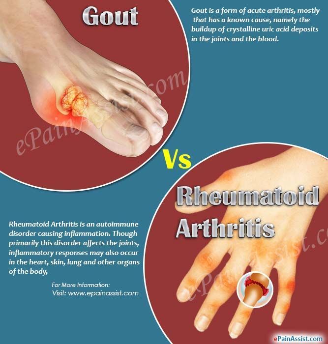 Gout Vs Rheumatoid Arthritis