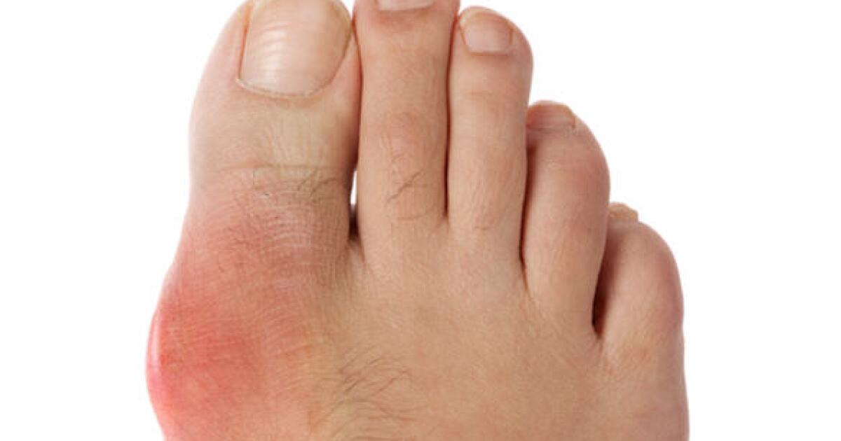 Gout: What It Is, Symptoms, Causes &  Treatment