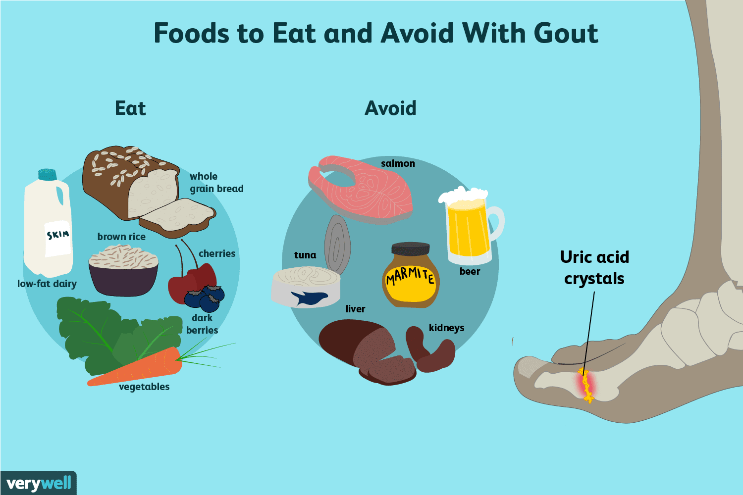 Gout: What to Eat for Better Management