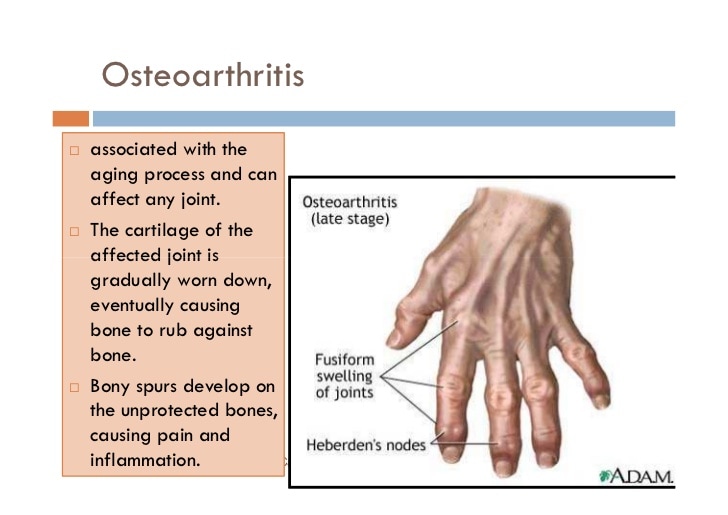 gouty arthritis pictures