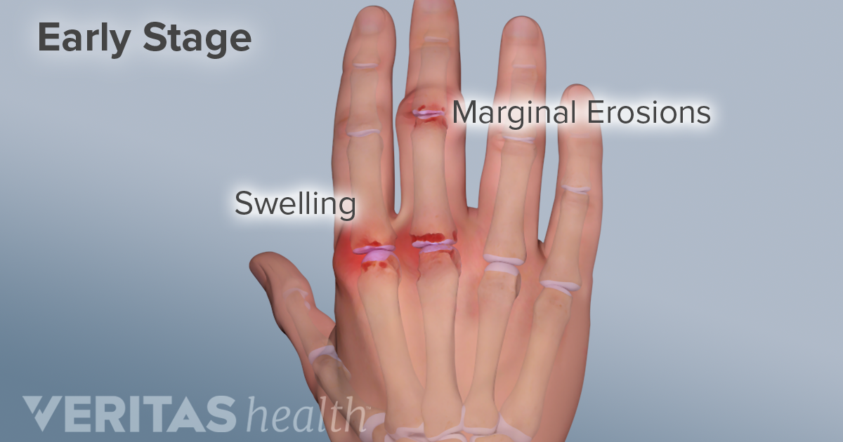 Hand Pain and Rheumatoid Arthritis