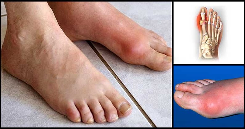 Helpful Tips To Prevent Gout Attacks