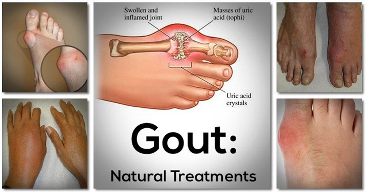 Here Is A Natural Treatment To Help You With Gout