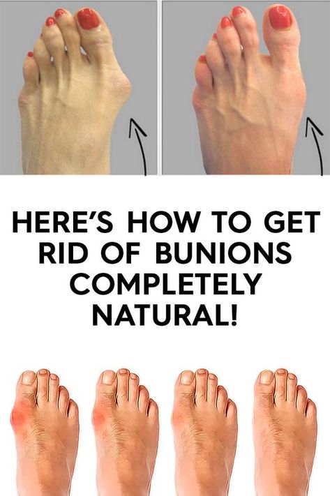 Hereâs how to get rid of bunions completely natural!