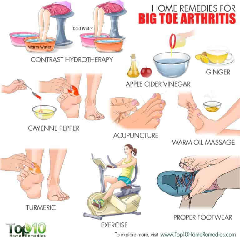 Home Remedies for Big Toe Arthritis