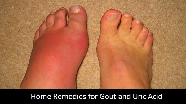 Home Remedies to Treat Gout and Uric Acid